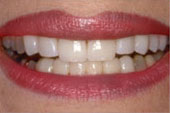 Veneers_A.jpg